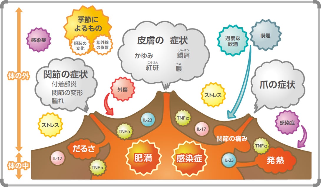 乾癬の発症のしくみ（イメージ）